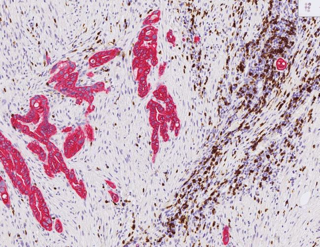 bukspottkörteltumör T-celler tumörceller.JPG (2)